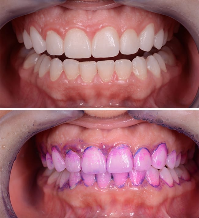 Guided Biofilm Therapy (GBT) Nedir? Modern Diş Temizliğinde Yeni Yaklaşım